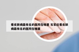 看皮膚病最有名的醫(yī)院在哪里 石家莊看皮膚病最有名的醫(yī)院在哪里