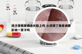 孩子得銀屑病會長臉上嗎 小孩得了銀屑病要影響一輩子嗎