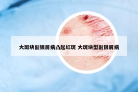 大斑塊副銀屑病凸起紅斑 大斑塊型副銀屑病