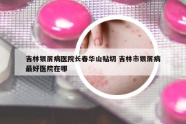 吉林銀屑病醫(yī)院長春華山貼切 吉林市銀屑病最好醫(yī)院在哪