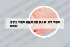 濟寧治療銀屑病醫(yī)院費用多少錢 濟寧市銀屑病醫(yī)院