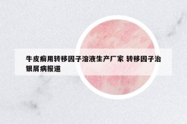 牛皮癬用轉(zhuǎn)移因子溶液生產(chǎn)廠家 轉(zhuǎn)移因子治銀屑病報(bào)道