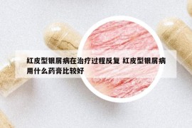 紅皮型銀屑病在治療過(guò)程反復(fù) 紅皮型銀屑病用什么藥膏比較好