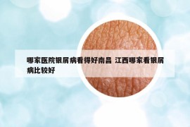 哪家醫(yī)院銀屑病看得好南昌 江西哪家看銀屑病比較好
