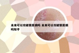 未來(lái)可以攻破銀屑病嗎 未來(lái)可以攻破銀屑病嗎知乎