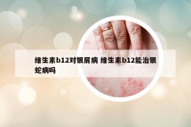 維生素b12對銀屑病 維生素b12能治銀蛇病嗎