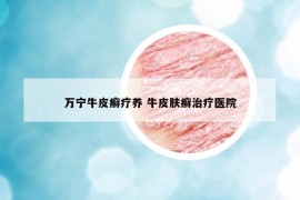 萬寧牛皮癬療養(yǎng) 牛皮膚癬治療醫(yī)院