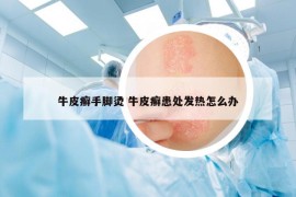 牛皮癬手腳燙 牛皮癬患處發(fā)熱怎么辦
