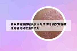 曲安奈德益康唑乳膏治療白斑嗎 曲安奈德益康唑乳膏可以治白斑嗎