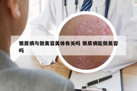 銀屑病與做美容美體有關(guān)嗎 銀屑病能做美容嗎