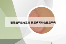 銀屑病不能吃豆腐 銀屑病可以吃豆腐干嗎