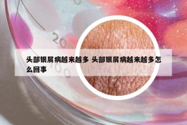 頭部銀屑病越來(lái)越多 頭部銀屑病越來(lái)越多怎么回事