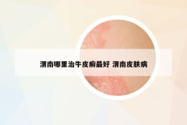 渭南哪里治牛皮癬最好 渭南皮膚病