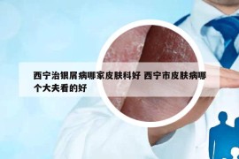 西寧治銀屑病哪家皮膚科好 西寧市皮膚病哪個(gè)大夫看的好