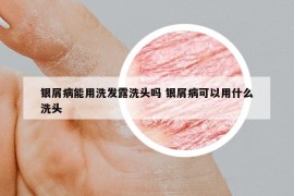 銀屑病能用洗發(fā)露洗頭嗎 銀屑病可以用什么洗頭