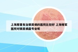 上海那里有治銀屑病的醫(yī)院比較好 上海哪家醫(yī)院對銀屑病最專業(yè)呢