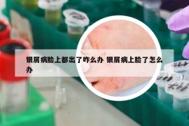 銀屑病臉上都出了咋么辦 銀屑病上臉了怎么辦