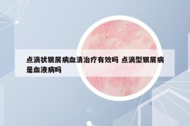 點滴狀銀屑病血清治療有效嗎 點滴型銀屑病是血液病嗎