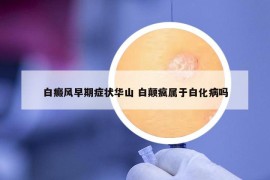 白癜風(fēng)早期癥狀華山 白顛瘋屬于白化病嗎