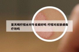 夏天喝檸檬水對(duì)牛皮癬好嗎 檸檬對(duì)皮膚病有療效嗎