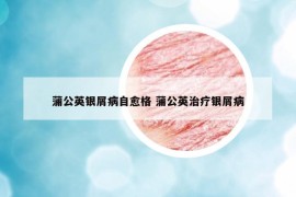 蒲公英銀屑病自愈格 蒲公英治療銀屑病