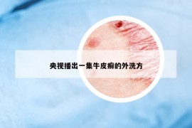 央視播出一集牛皮癬的外洗方