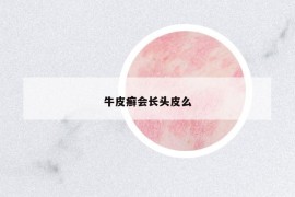 牛皮癬會(huì)長頭皮么