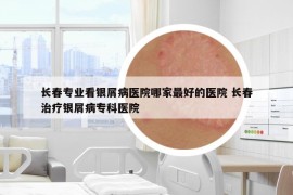 長春專業(yè)看銀屑病醫(yī)院哪家最好的醫(yī)院 長春治療銀屑病?？漆t(yī)院