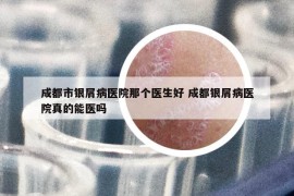 成都市銀屑病醫(yī)院那個(gè)醫(yī)生好 成都銀屑病醫(yī)院真的能醫(yī)嗎