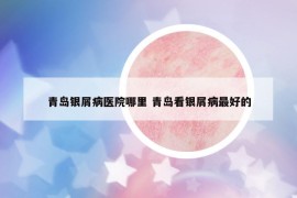 青島銀屑病醫(yī)院哪里 青島看銀屑病最好的
