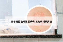 三七粉能治療銀屑病嗎 三七粉對(duì)銀屑病