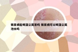 銀屑病能喝蒲公英茶嗎 銀屑病可以喝蒲公英泡水嗎