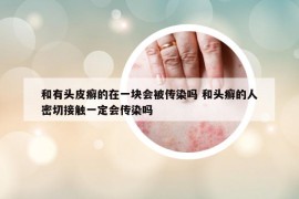 和有頭皮癬的在一塊會(huì)被傳染嗎 和頭癬的人密切接觸一定會(huì)傳染嗎