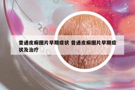 普通皮癬圖片早期癥狀 普通皮癬圖片早期癥狀及治療