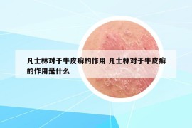 凡士林對(duì)于牛皮癬的作用 凡士林對(duì)于牛皮癬的作用是什么