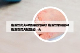脂溢性皮炎和銀屑病的癥狀 脂溢性銀屑病和脂溢性皮炎區(qū)別是什么