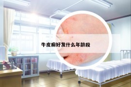 牛皮癬好發(fā)什么年齡段