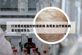 打青霉素就能好的銀屑病 青霉素治療銀屑病最長輸液多久