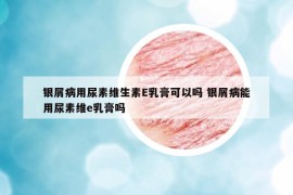 銀屑病用尿素維生素E乳膏可以嗎 銀屑病能用尿素維e乳膏嗎