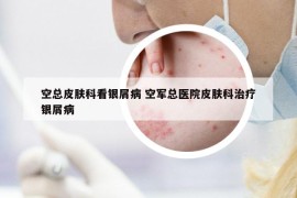 空總皮膚科看銀屑病 空軍總醫(yī)院皮膚科治療銀屑病