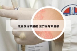 北豆根治銀屑病 豆方治療銀屑病