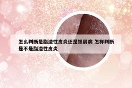 怎么判斷是脂溢性皮炎還是銀屑病 怎樣判斷是不是脂溢性皮炎