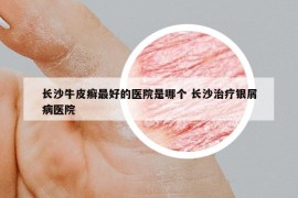 長(zhǎng)沙牛皮癬最好的醫(yī)院是哪個(gè) 長(zhǎng)沙治療銀屑病醫(yī)院