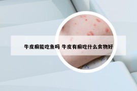 牛皮癬能吃魚嗎 牛皮有癬吃什么食物好