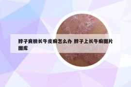 脖子肩膀長牛皮癬怎么辦 脖子上長牛癬圖片圖庫