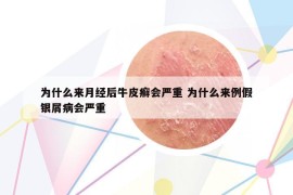 為什么來月經(jīng)后牛皮癬會嚴(yán)重 為什么來例假銀屑病會嚴(yán)重