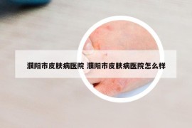 濮陽市皮膚病醫(yī)院 濮陽市皮膚病醫(yī)院怎么樣