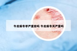 牛皮癬冬季嚴(yán)重些嗎 牛皮癬冬天嚴(yán)重嗎