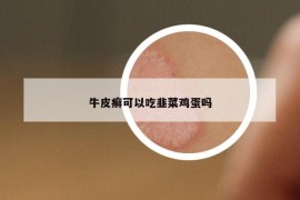 牛皮癬可以吃韭菜雞蛋嗎
