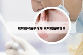 銀屑病和疤痕疙瘩 銀屑病疤痕增生